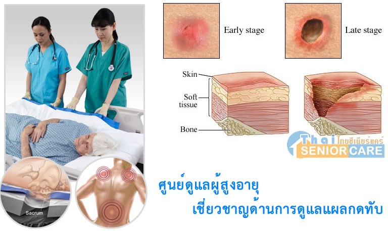 ศูนย์ดูแลผู้สูงอายุ เชี่ยวชาญด้านการดูแลแผลกดทับ